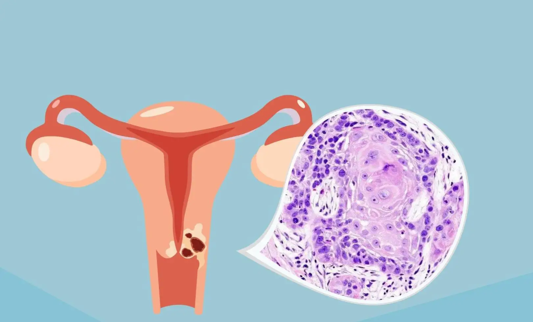 不疼不癢，竟然查出“宮頸癌”！這“3個(gè)信號”要警惕！